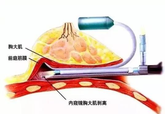 www.8682.cc徐国建隆胸厉害技术图