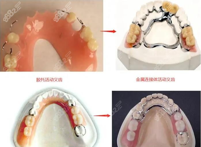 不同种类的活动假牙