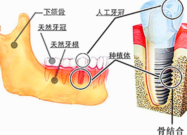种植牙在牙槽骨内的图片
