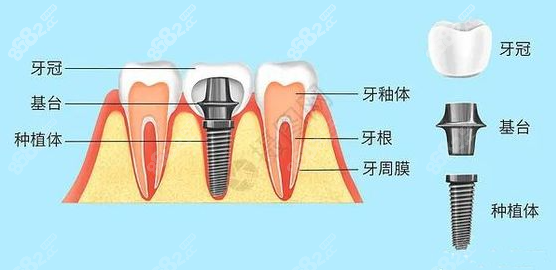 <!--<i data=20240705-sp></i>-->口腔种植牙怎么样