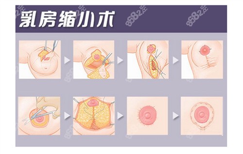 缩胸手术的疤痕图片真实