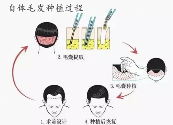 <!--<i data=20240705-sp></i>-->整形植发科怎么样
