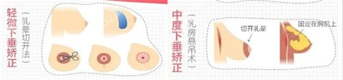 巨乳下垂的矫正方法