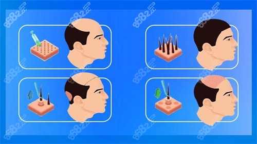 韩国植发价格是多少？