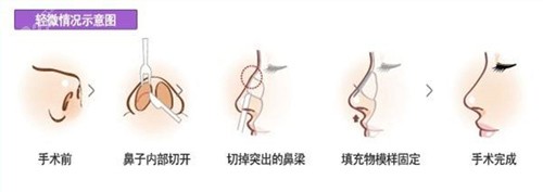 假体隆鼻歪斜取出手术原理图