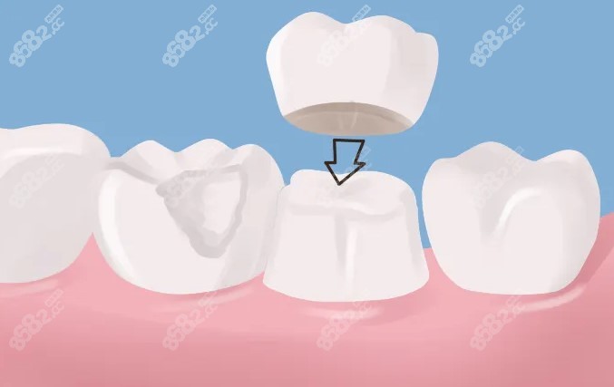 南通全瓷牙冠价格收费多少钱m.8682.cc