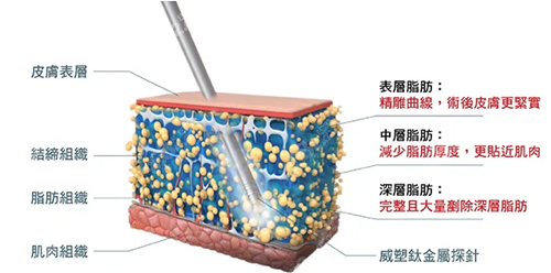 威塑吸脂