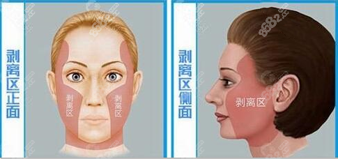 面部五层生物提升手术图示