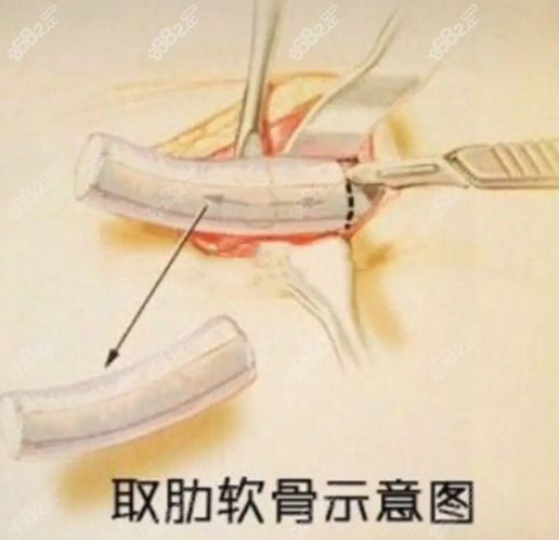 肋骨隆鼻鼻尖会回缩多少