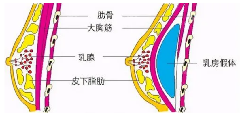 假体隆胸手术