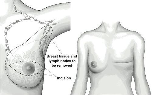 乳房切除后做假体隆胸介绍m.8682.cc