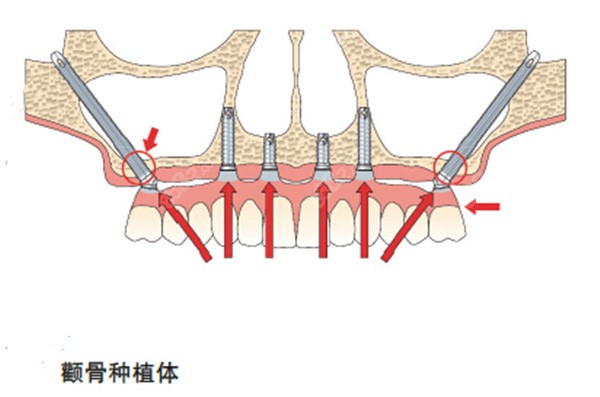 杭州萧山医院口腔科种植技术8682.cc