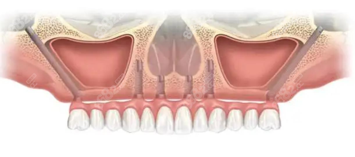 全口种植牙