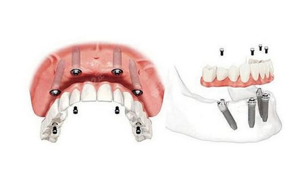 余杭全口种植牙价格8682.cc