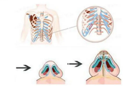 肋骨垫鼻尖会一年比一年矮吗www.8682.cc