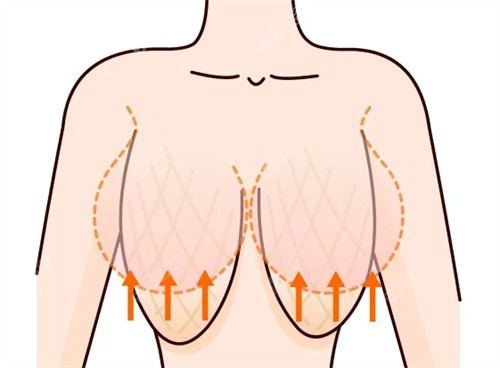 缩胸手术帮助矫正乳房下垂