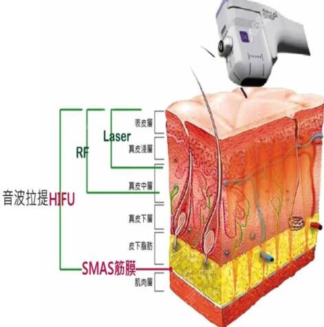 北京加减美拉皮怎么样