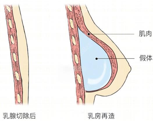 乳房切除后做假体隆胸多少钱