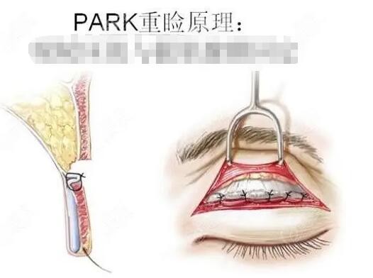 Park双眼皮原理是什么
