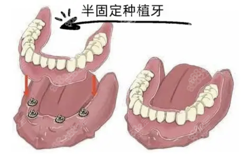 <!--<i data=20240705-sp></i>-->口腔全口半固定种植牙价格：4万元起