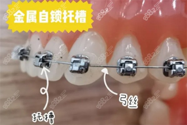 传统金属牙套和金属自锁的区别