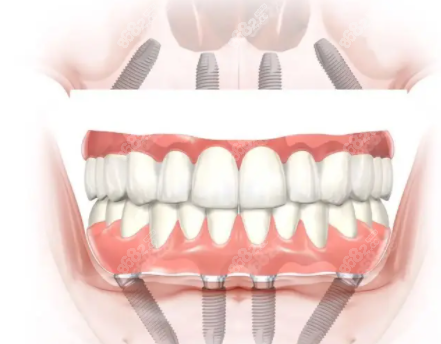 鸡西正植口腔全口种植牙技术优势