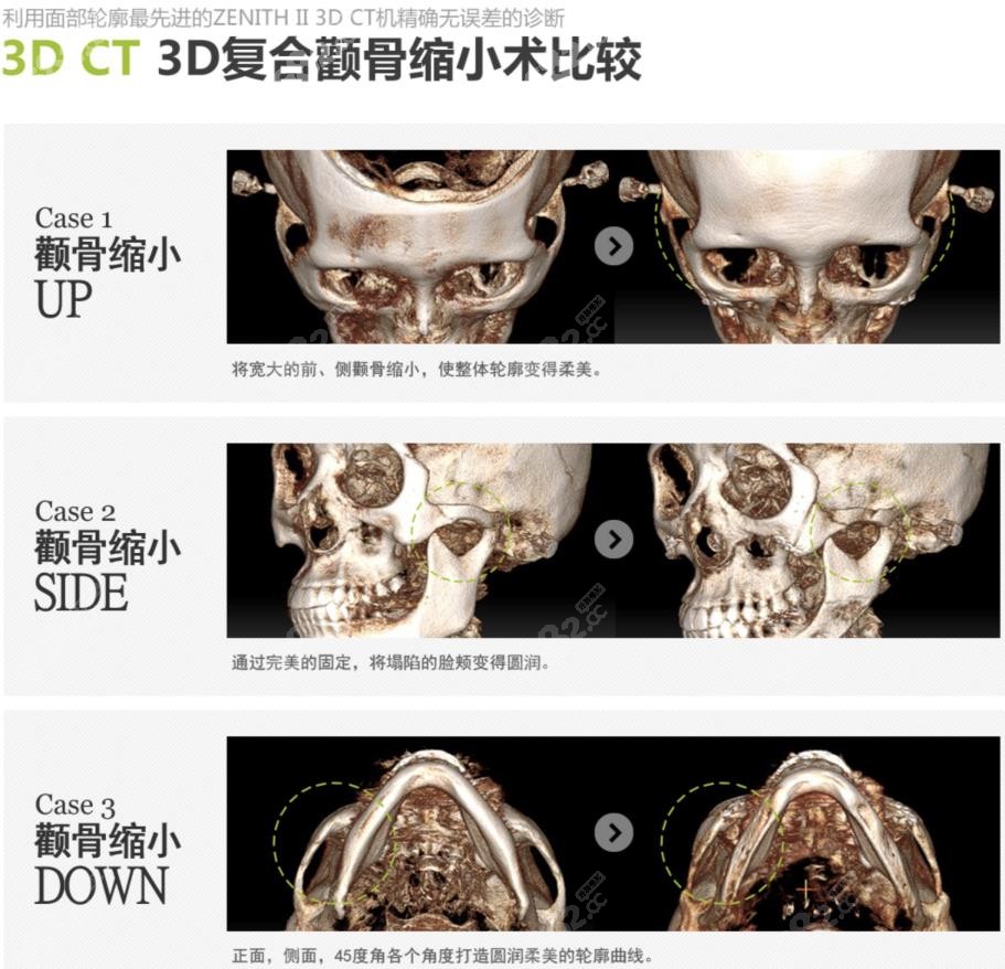 3D复合额骨缩小术比较