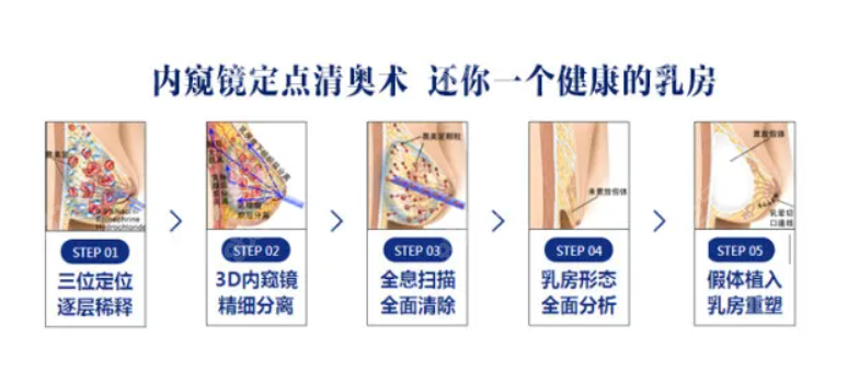 全息六维层清奥术取乳房奥美定过程和操作步骤