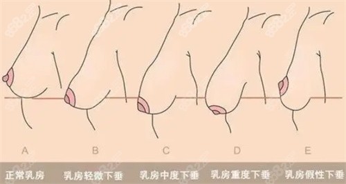 胸部下垂的各种表现有哪些？