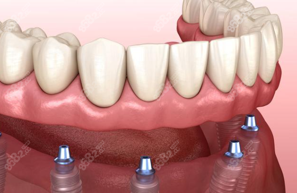 老年全口种植牙医院哪家好8682.cc