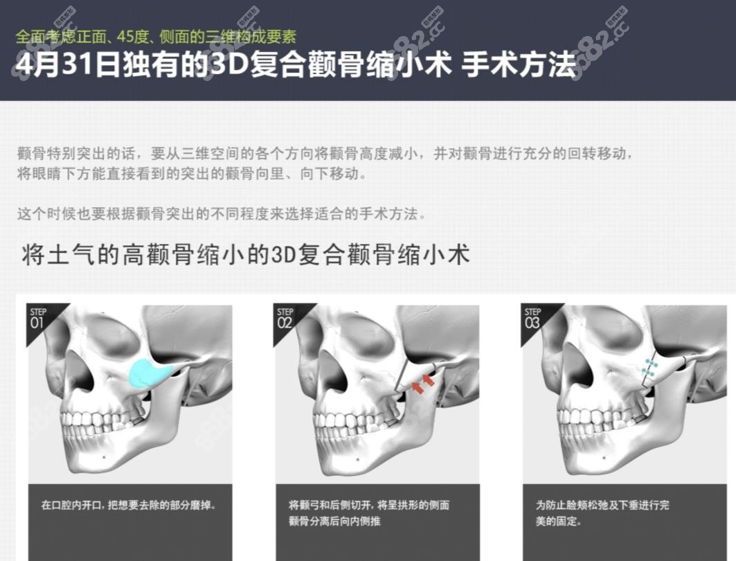 韩国431颧骨缩小手术特色