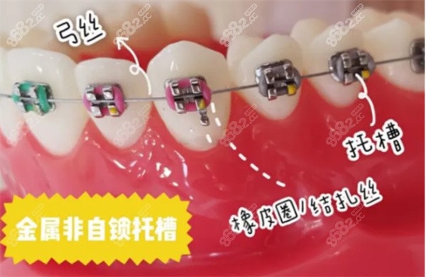 传统金属牙套和金属自锁的区别