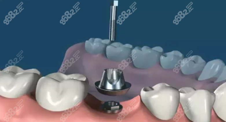 种植牙手术图示