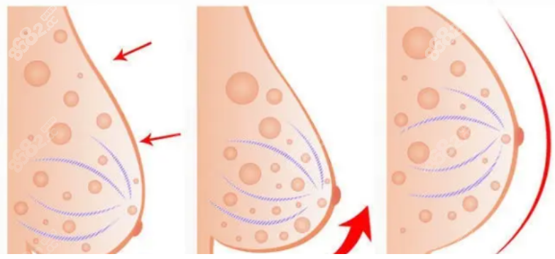 乳头照片丰胸图片