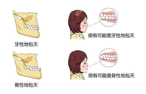 骨性还是牙性地包天图片对比