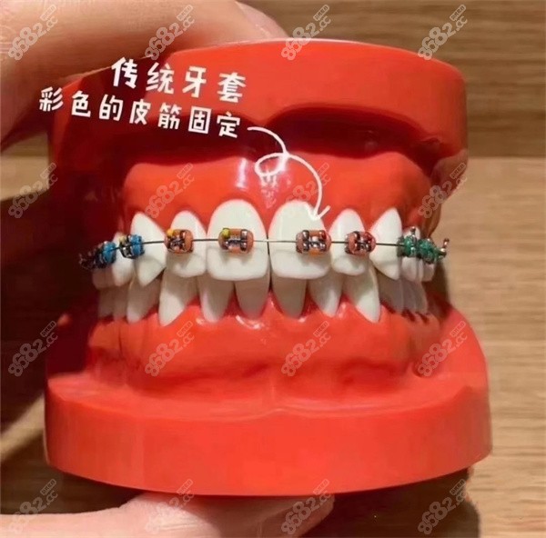 传统金属牙套和金属自锁的区别