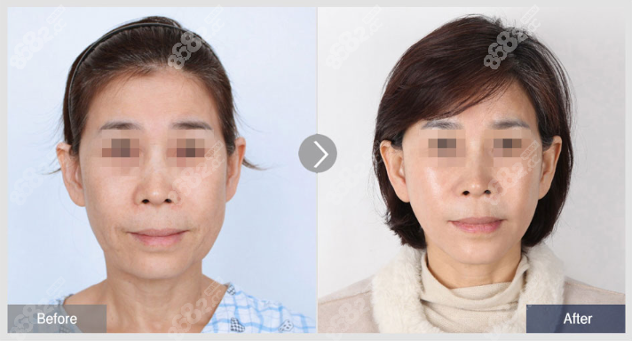 韩国菲斯莱茵李泰喜面部拉皮手术实例照片