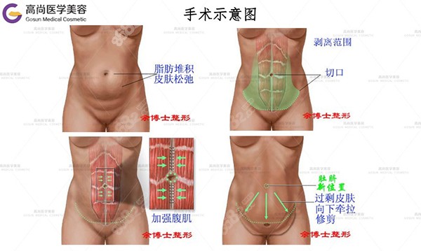 腹壁整形手术