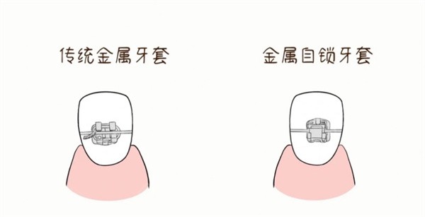 传统金属牙套和金属自锁的区别,从价格/时间/优缺点分析