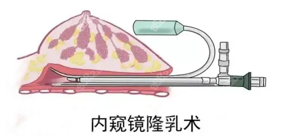 南阳内窥镜隆胸手术www.8682.cc