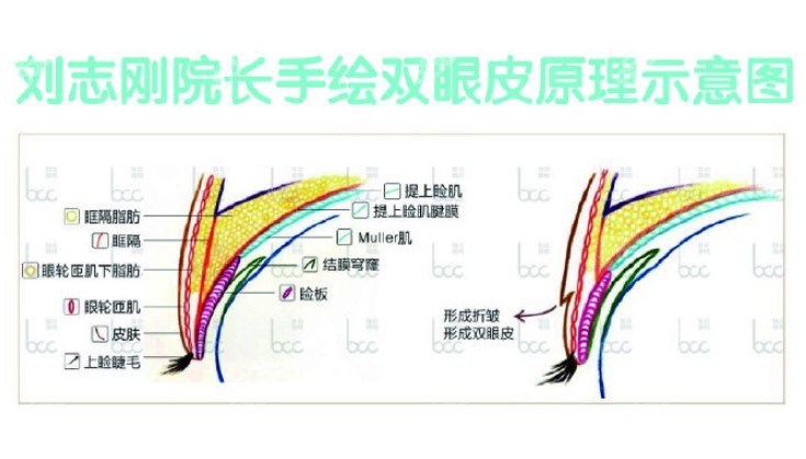 刘志刚肉条感双眼皮修复