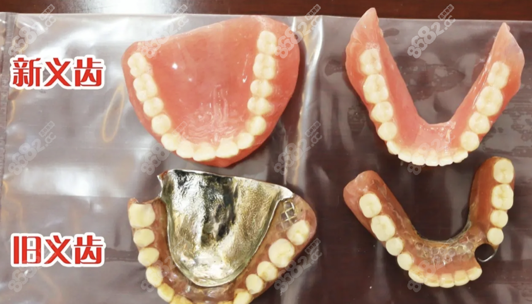 传统假牙和吸附性假牙区别