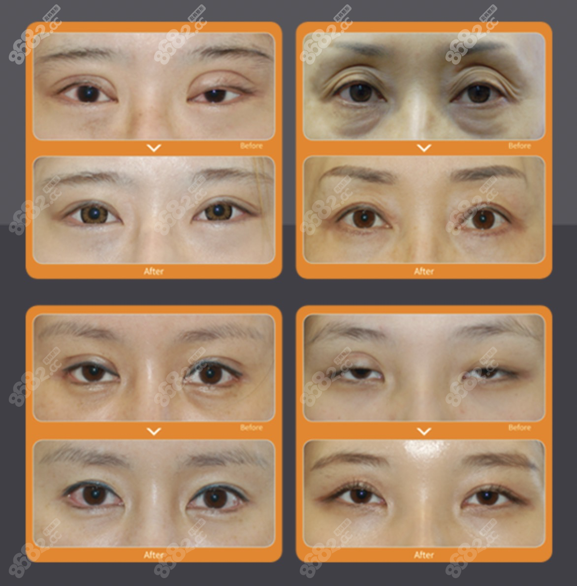 朴相炫医生双眼皮修复对比图8682.cc