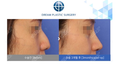 韩国梦想整形外科医院鼻型矫正怎么样