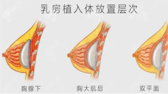 假体隆胸手术8682.cc