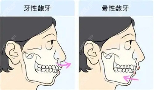 牙性凸嘴和骨性凸嘴有着本质区别