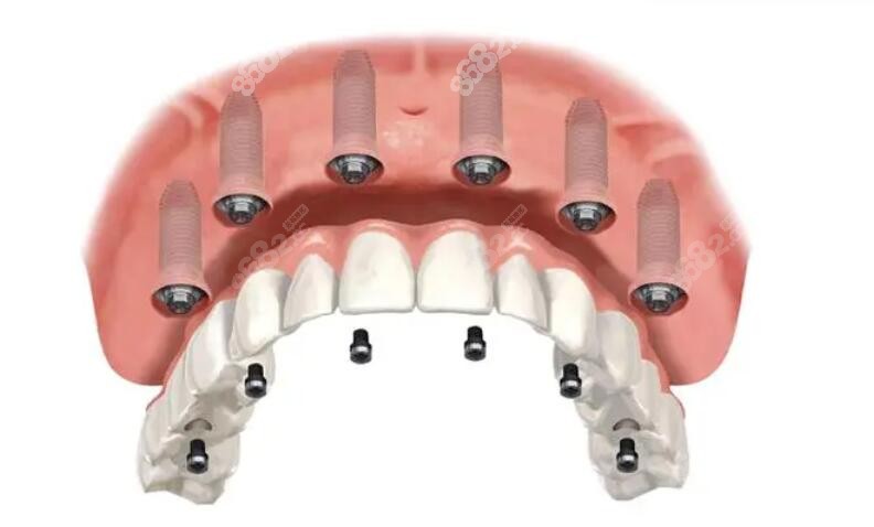 all-on-6种植覆盖义齿