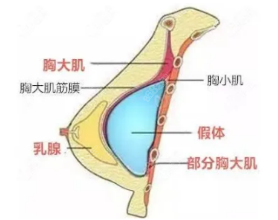 罗盛康医生隆胸