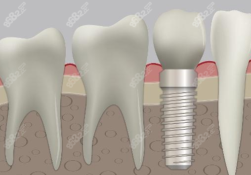 种植牙示意图
