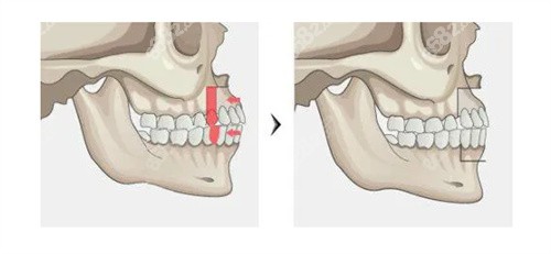 骨性凸嘴需采取正颌手术